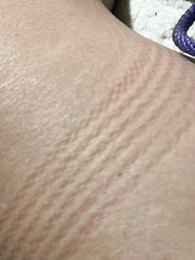 Rope marks